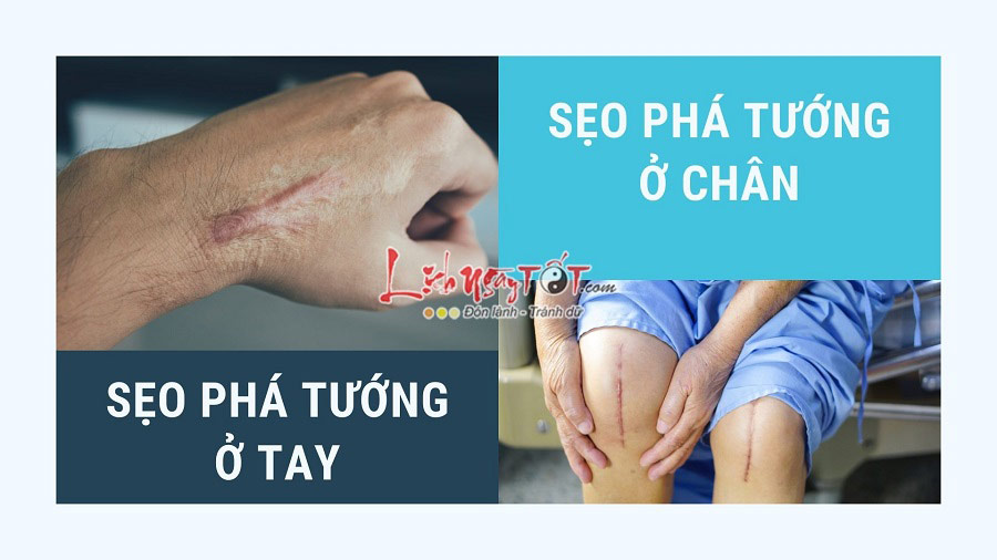 Seo pha tuong o tay, chan